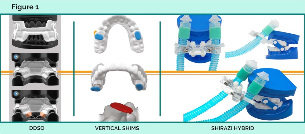 Severe OSA Versatile treatment