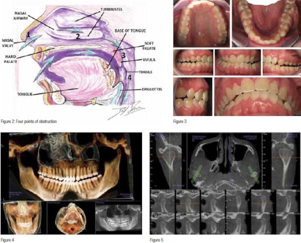 Non-Surgical Improvements of Facial Structure